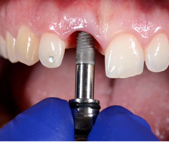 Dental Implants Aurora, Ontario